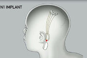 일론 머스크 "뉴럴링크 '뇌 이식 칩' 이명 치료 가능하다"